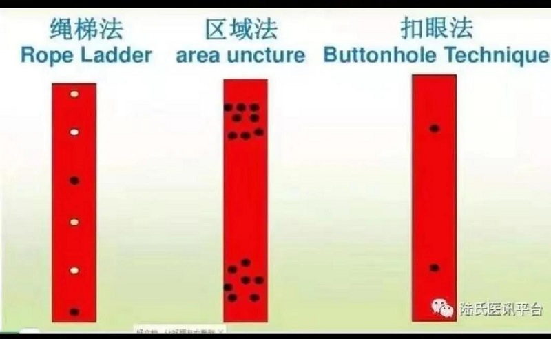 绳梯式穿刺保护血液透析患者"生命线"-学术交流-尉氏